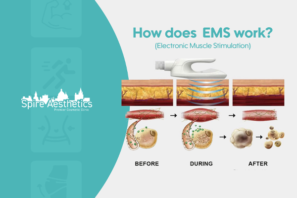 EMS treatment for post pregnancy weight loss treatment Marlow
