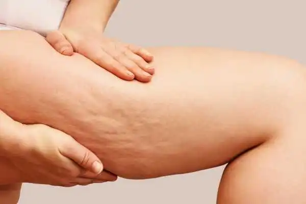 Image of woman showing leg with cellulite Marlow