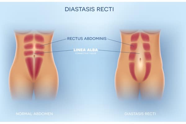 What Non-Surgical Options Are Available for Diastasis Recti Marlow?