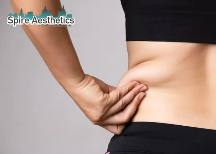 Image of woman pinching fat on their hips Marlow. Fat Freezing treatment