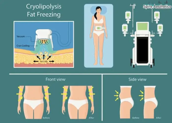 Fat freezing treatment Marlow benefits for competitions to remove stubborn fat deposits.