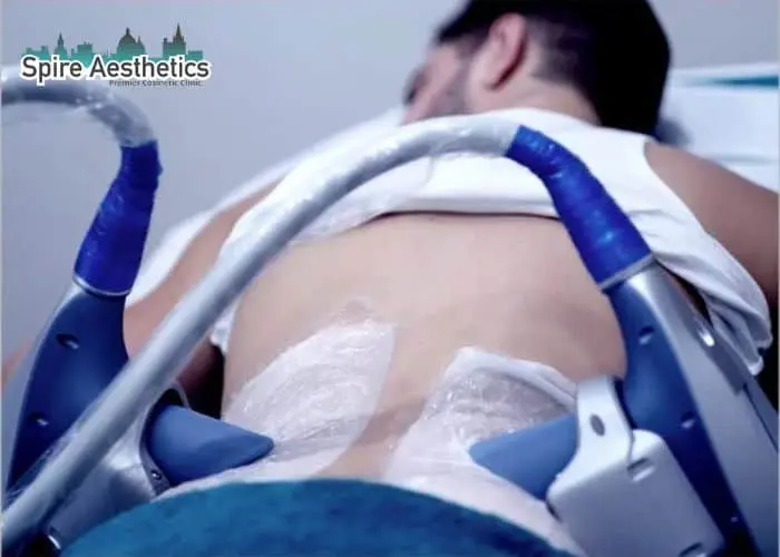 Man having fat freezing treatment done on love handles before a competitions Marlow to create a sculpted look.