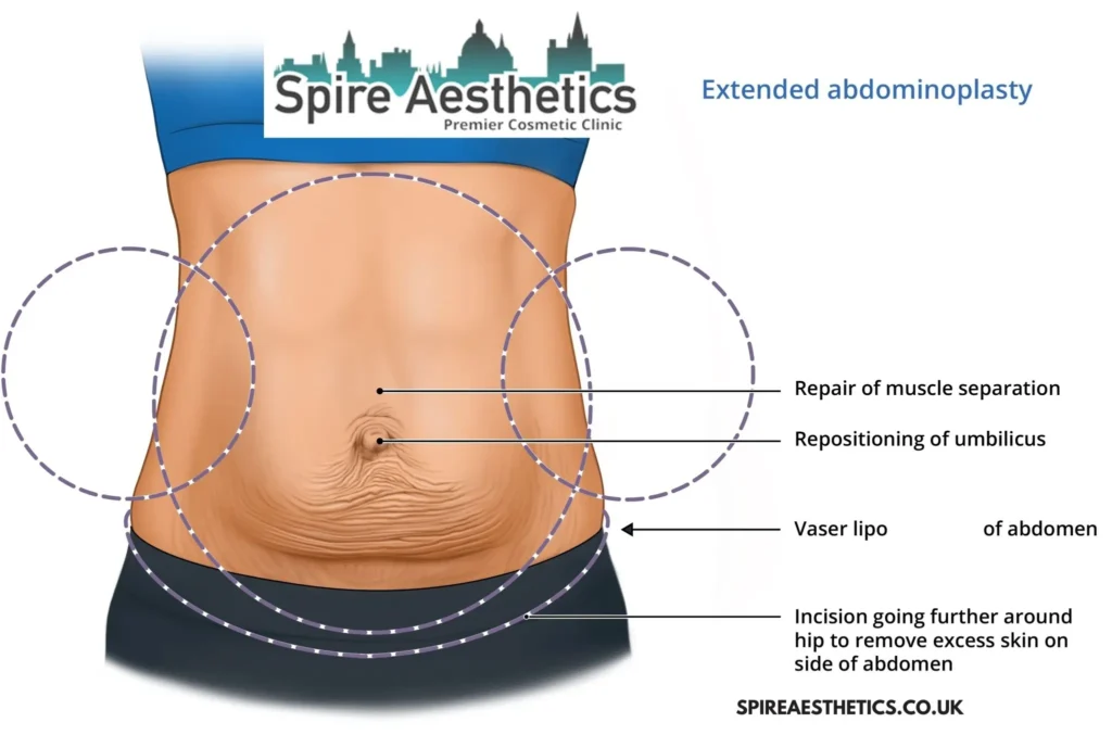 Understanding Loose Skin After Gastric Band Marlow Surgery and HIFU Treatment