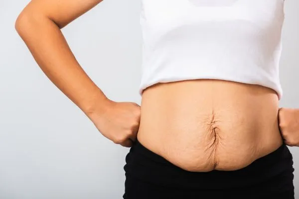Image of a woman's stomach after weight loss with sagging skin following a gastric band Marlow
