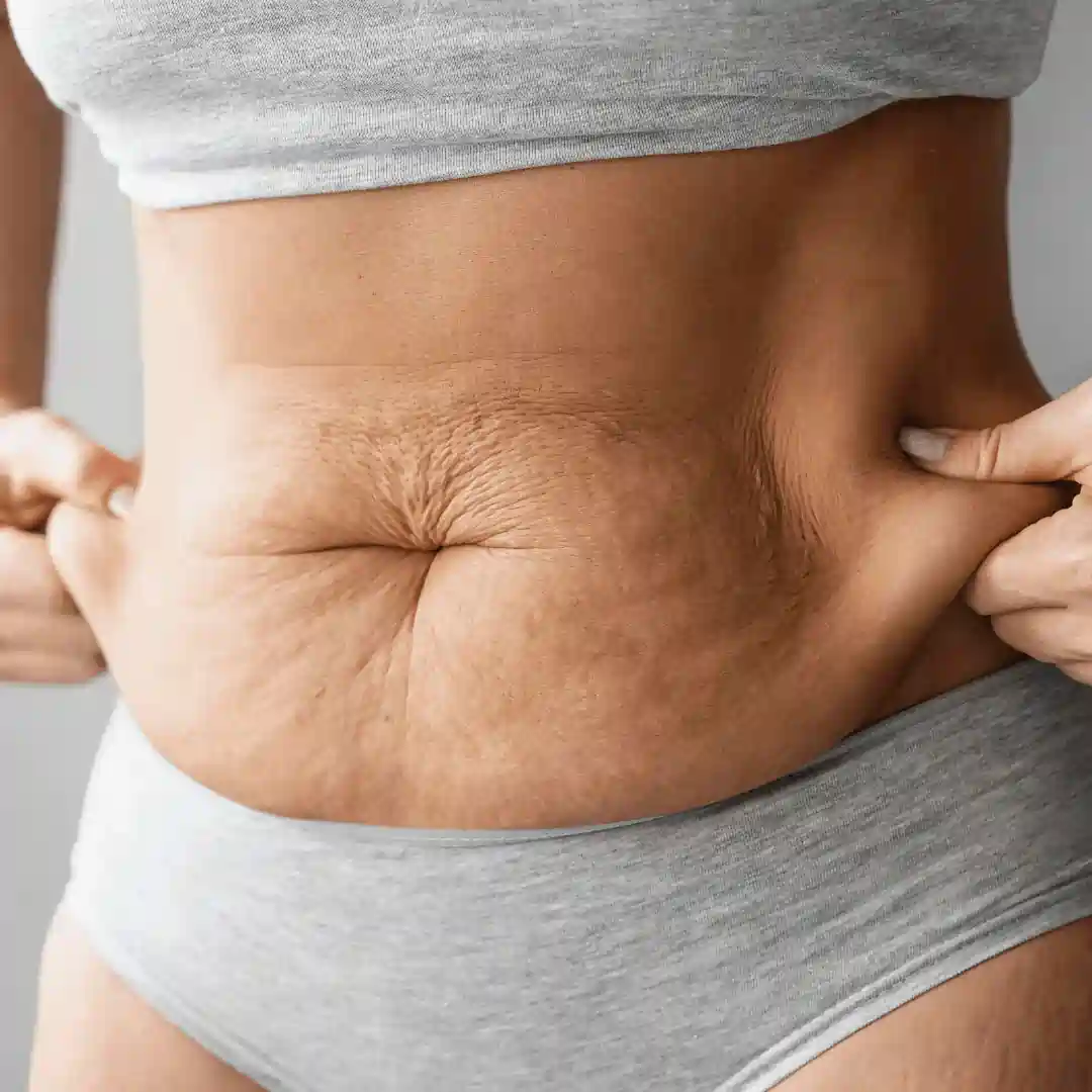 Is It Normal to Have Loose Skin After Pregnancy Marlow?