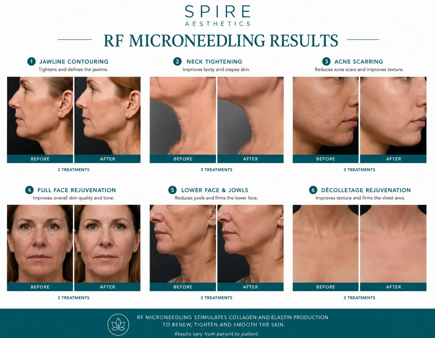 RF Microneedling Skin tightening Marlow results