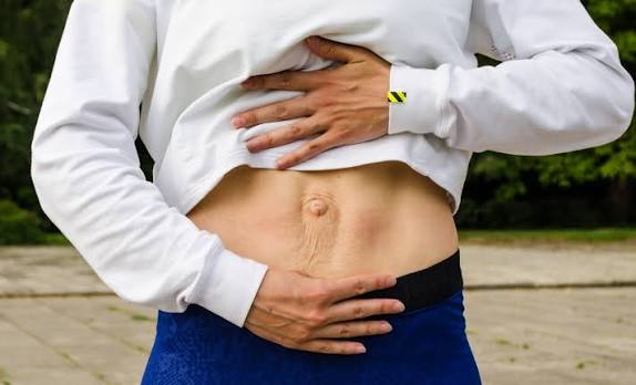 When Could Diastasis Recti Be the Missing Piece of the Puzzle Marlow?
