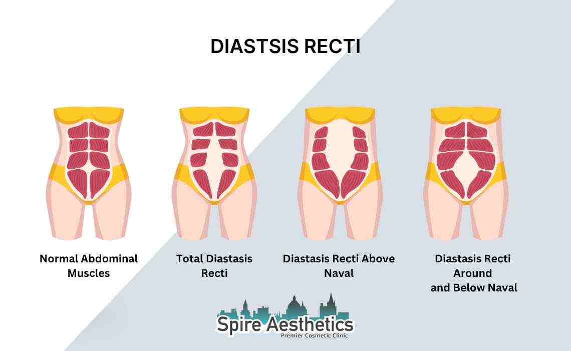 Is Non-Surgical Diastasis Recti Treatment Right for You? Common Concerns Answered Marlow